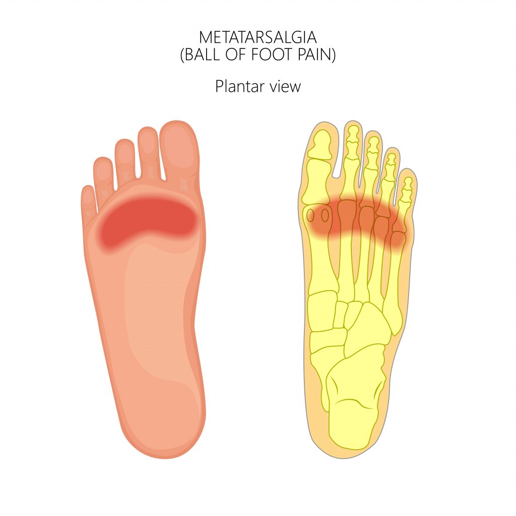 What Is Metatarsalgia? | Applied Biomechanics Orthotics & Bracing Guelph