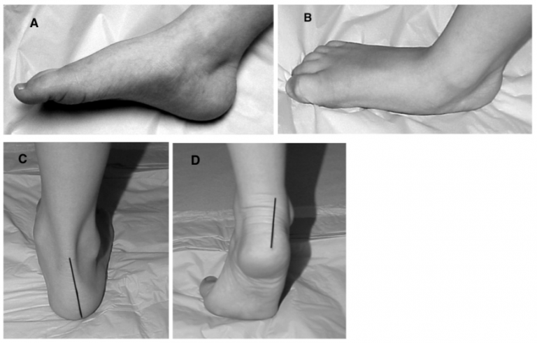 Paediatric Flatfoot & Treatments | Applied Biomechanics Guelph