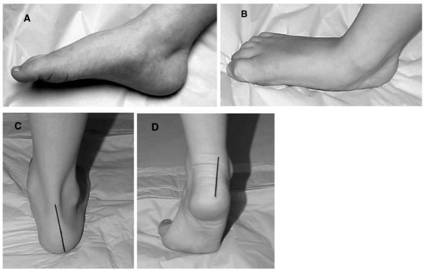 Paediatric Flatfoot & Treatments