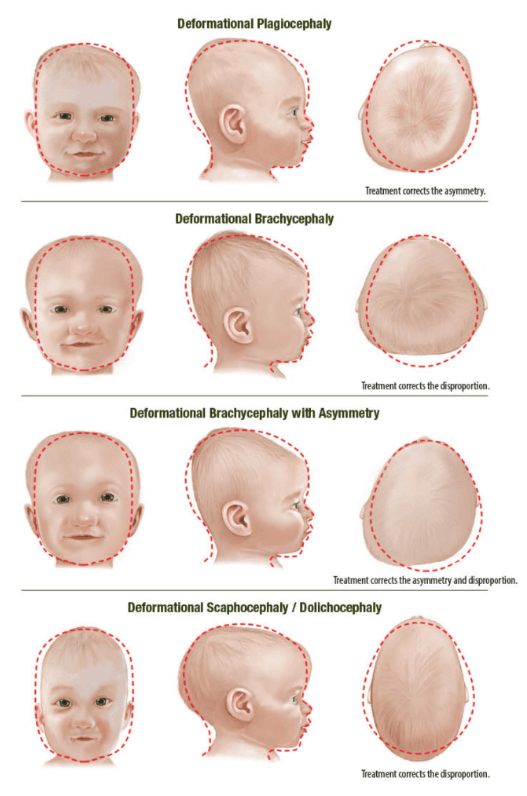 An illustrated diagram showing Plagiocephaly, brachycephaly, and scaphocephaly/dolichocephaly deformities in babies.