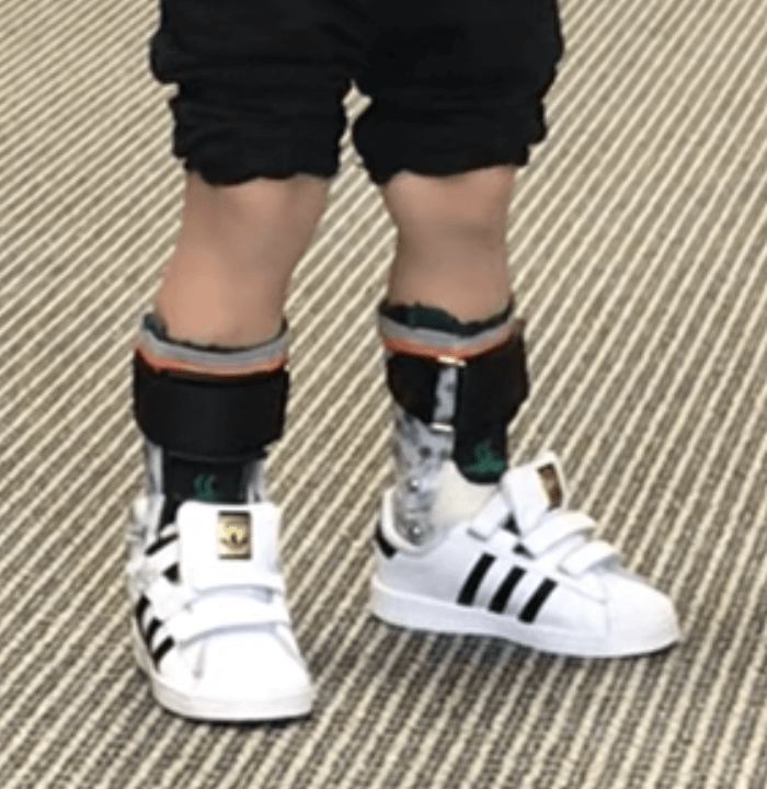 A child wearing custom ankle foot orthoses by Applied Biomechanics. 