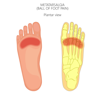 What Is Metatarsalgia?