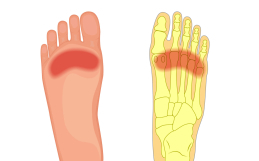 What Is Metatarsalgia?