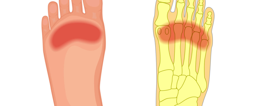 What Is Metatarsalgia?