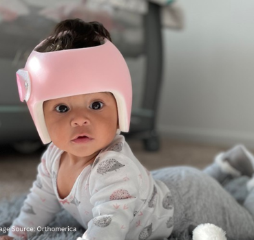 Does My Baby Need A Cranial Remolding Helmet?