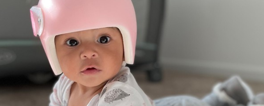 Does My Baby Need A Cranial Remolding Helmet?