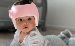 Does My Baby Need A Cranial Remolding Helmet?